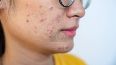 Gros plan de la femme asiatique inquiète ayant l'acné enflammée sur son visage. L'acné enflammée consiste en un gonflement, une rougeur et des pores profondément obstrués par des bactéries, de l'huile et des cellules mortes de la peau..