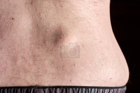 Photo for Small round lipoma on the lower back of young caucasian man against dark black background. - Royalty Free Image