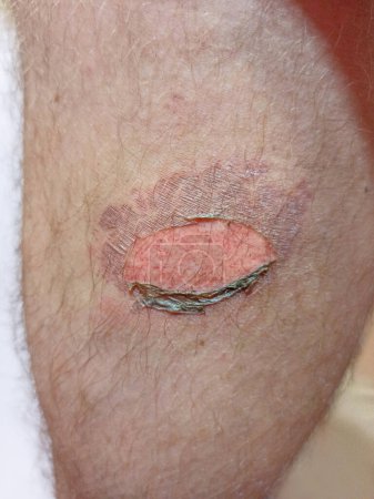 Photo for Leg burn with hot metal. View of human leg after being burned by hot metal. Burn on person leg on day of burn and after. Human leg one week after scald. Medical concept. Spot on human skin after burn - Royalty Free Image