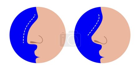 Ilustración de Comparación de nariz torcida y recta, antes y después de la corrección de la rinoplastia. Nariz efecto cirugía plástica, ilustración vector médico, aislado sobre un fondo blanco. - Imagen libre de derechos