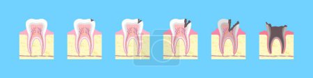 Ilustración de Proceso de destrucción cariosa de los dientes. Formación ósea saludable con fisura negra e inflamación gradual. Caries esmaltado con infección dental y pérdida completa de vectores - Imagen libre de derechos