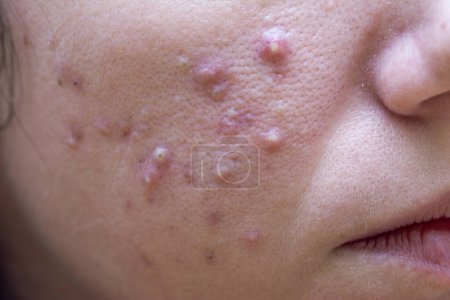 Caucasian female with cystic acne from clogged pores and oily skin