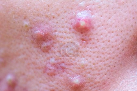 Caucasian female with cystic acne from clogged pores and oily skin