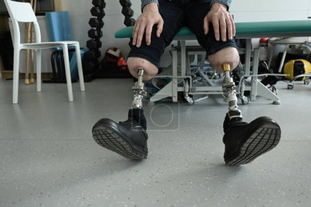 a man with bone-implanted leg prostheses. osteointegration