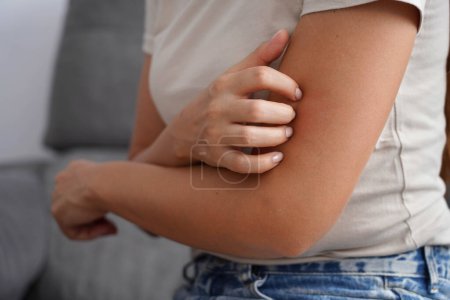 El primer plano de una mujer irreconocible se rasca el brazo con las uñas. Dermatitis, picor, alergia, nerviosismo e irritación.