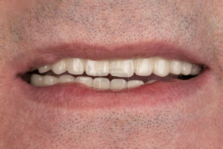Photo for Porcelain crowns and veneers on teeth - Royalty Free Image