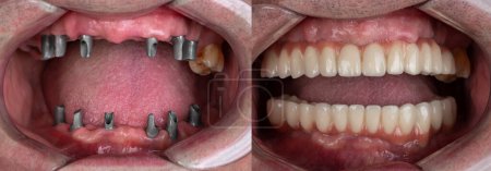 Téléchargez les photos : Before and after pictures of dental implants and press ceramic crowns - en image libre de droit