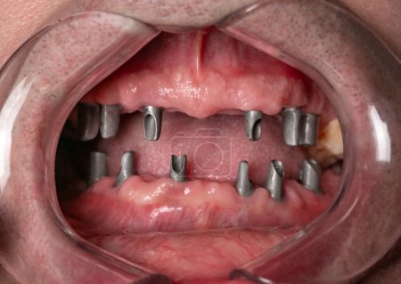 Téléchargez les photos : Close up of man's teeth with retractor for mouth. Patient at the dentist  .surgical dental template in the oral cavity with  installed implants - en image libre de droit
