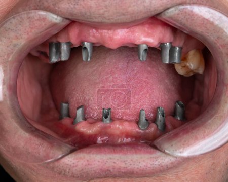 Foto de Close up of man's teeth with retractor for mouth. Patient at the dentist  .surgical dental template in the oral cavity with  installed implants - Imagen libre de derechos