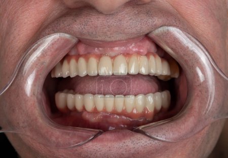 Foto de Close up of man cavity protected by retractor showing perfect teeth.implants and pressed ceramic crowns - Imagen libre de derechos