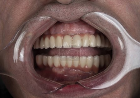 Photo for Close up of man cavity protected by retractor showing perfect teeth.implants and pressed ceramic crowns - Royalty Free Image