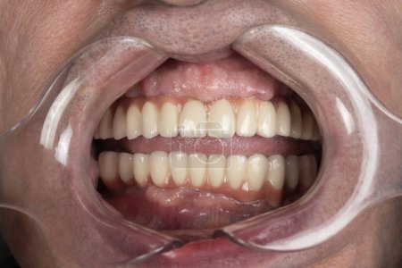 Téléchargez les photos : Close up of man cavity protected by retractor showing perfect teeth.implants and pressed ceramic crowns - en image libre de droit