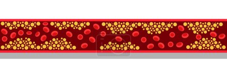 Illustration for Cholesterol level on blocked blood vessel medical bad hdl lipoprotein. High and low fat test indicator. Atherosclerosis risk. Healthcare concept. Vector illustration - Royalty Free Image