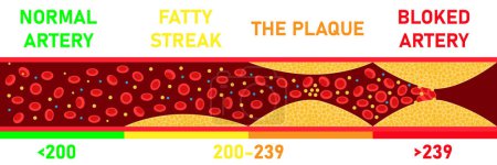 Cholesterol level on blocked blood vessel medical bad hdl lipoprotein. High and low fat test indicator. Atherosclerosis risk. Healthcare concept. Vector illustration