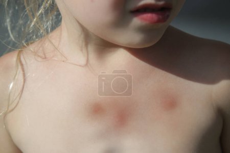 Photo for Little girl has skin rash from allergy or mosquito bites - Royalty Free Image