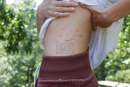 Rote, geschwollene und juckende Flecken auf der Haut, verursacht durch Insektenstiche oder Allergien. Hautreaktion auf Insektenstiche.