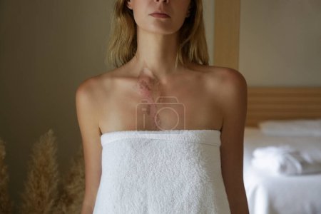 Photo for A second-degree burn with peeling skin on woman's chest - Royalty Free Image