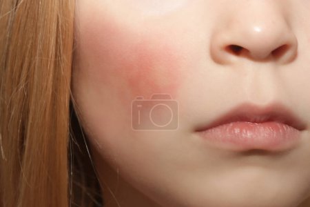 Foto de Enrojecimiento en las mejillas del niño causado por eccema, piel seca o alergia - Imagen libre de derechos