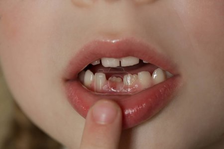 Jolie fille préscolaire montrant une dent primaire lâche (bébé)