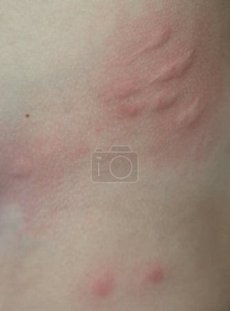 Taches rouges, gonflées et démangeaisons sur la peau causées par des piqûres d'insectes ou une allergie. Réaction cutanée aux piqûres d'insectes.