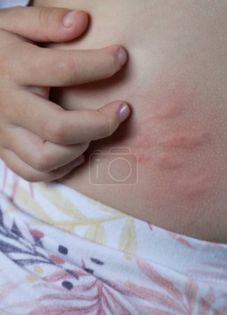 Taches rouges, gonflées et démangeaisons sur la peau causées par des piqûres d'insectes ou une allergie. Réaction cutanée aux piqûres d'insectes.