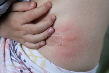 Rote, geschwollene und juckende Flecken auf der Haut, verursacht durch Insektenstiche oder Allergien. Hautreaktion auf Insektenstiche.