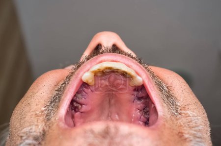 Téléchargez les photos : Détail du palais mâle supérieur avec la gencive cousue après l'extraction des molaires, avec attelage sur les dents de l'incisive. - en image libre de droit