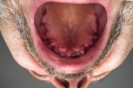 Photo for Upper male palate with gum grafts after extraction of all teeth. - Royalty Free Image