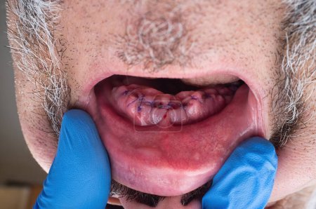 Téléchargez les photos : Bouche mâle supérieure avec greffe de gomme après extraction de toutes les dents. - en image libre de droit