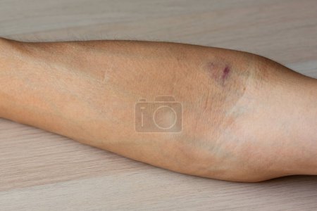 Photo for Ecchymosis on the man arm from the blood draw needle. - Royalty Free Image