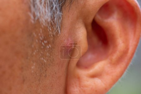 Foto de Vista de cerca del acné nodular preauricular en el hombre de edad avanzada asiático. - Imagen libre de derechos