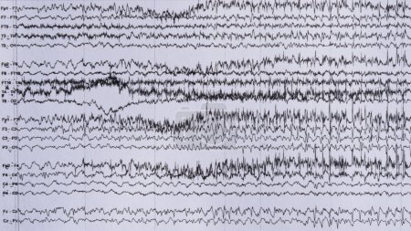 Téléchargez les photos : Imaging of ictal EEG recording in epilepsy patient during monitoring. - en image libre de droit