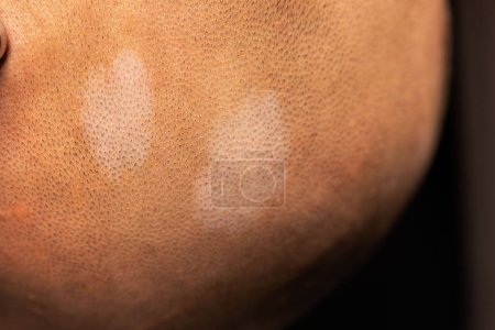 Nahaufnahme der hypomelanotischen Makula oder des weißen Flecks auf der Kopfhaut bei Tuberoser Sklerose.