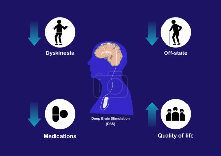 Ilustración de Concepts of deep brain stimulation for treatment of Parkinson's disease. - Imagen libre de derechos