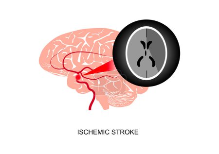 Illustration for Illustration of cerebral ischemic stroke and CT imaging. - Royalty Free Image