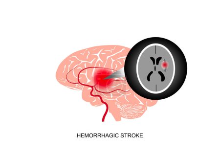 Illustration for Illustration of cerebral hemorrhagic stroke and brain imaging. - Royalty Free Image