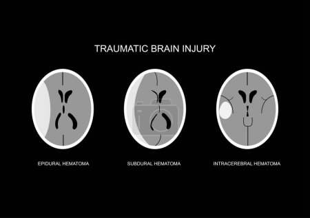 Illustration for Illustration of common imaging following traumatic brain injury. Epidural hematoma, acute subdural hematoma, intracerebral hematoma. - Royalty Free Image