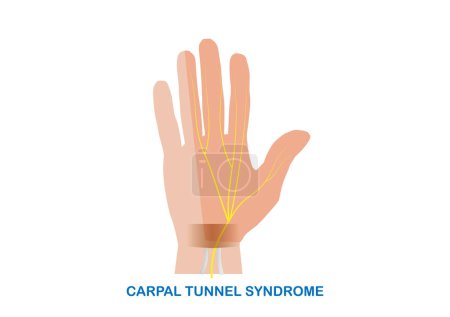 Téléchargez les illustrations : Illustration vectorielle piégeage nerveux médian au niveau du poignet ou syndrome du canal carpien. - en licence libre de droit