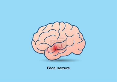 Ilustración del cerebro y ondas cerebrales anormales que representan epilepsia del lóbulo temporal.