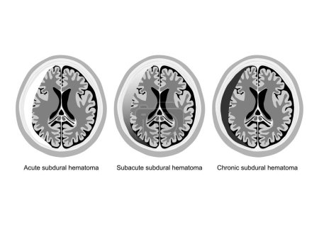 Stadien subduraler Hämatome im Gehirn veranschaulicht