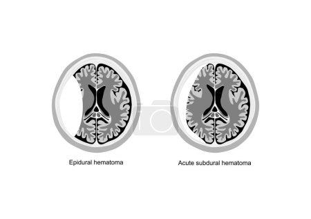 Comparative medical illustration of epidural and acute subdural hematoma in the human brain.