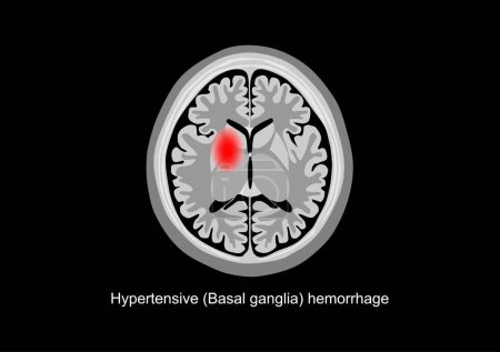 Téléchargez les illustrations : Hémorragie ganglionnaire basale Illustration par balayage cérébral - en licence libre de droit