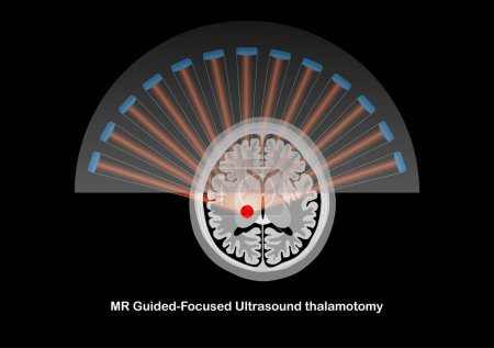 Téléchargez les illustrations : Thalamotomie focalisée par ultrasons guidée par RM pour le traitement des tremblements. - en licence libre de droit