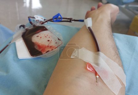 Limb of the volunteer blood donor during the donation with the needle inserted into the arm and the tube of blood
