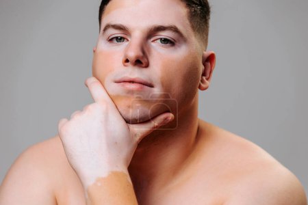 Foto de Hombre joven vitiligo plantea fondo gris en el estudio que muestra la belleza del cuerpo afectado enfermedad. La autoaceptación y el autocuidado es lo más importante en la vida de las personas con afecciones de la piel.. - Imagen libre de derechos