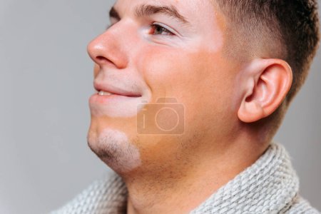 Téléchargez les photos : Vue latérale regardant le portrait de l'avenue de profil sur un fond de studio gris d'un jeune homme regardant avec un beau regard heureux. Une personne avec une pigmentation symétrique célèbre le jour du vitiligo avec joie. - en image libre de droit