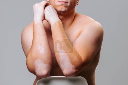 Unrecognizable studio shot human body vitiligo young male shows depigmentation of the skin. The concept of accepting your body from nature. Close up hands, part of face. Gray background.