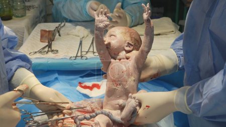 Foto de El médico retira al bebé del abdomen de la madre y corta el cordón umbilical. Sólo un bebé nato levanta los brazos. Primer plano. Parto por cesárea. - Imagen libre de derechos