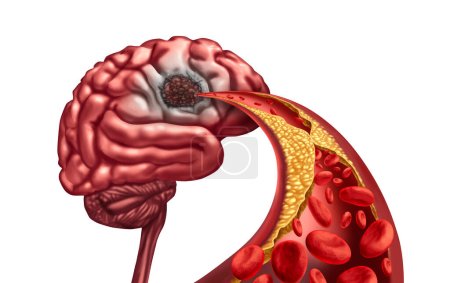 Démence vasculaire et nécrose liquéfactive cérébrale due à une perte de circulation sanguine dans l'esprit après un accident vasculaire cérébral causé par un blocage des artères entraînant des lésions des tissus morts et une fonction mentale avec des éléments de rendu 3D