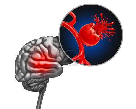 Ruptured brain Aneurysm as a medical concept with a bulging blood vessel as a ballooning artery with a rupture bleeding blood and causing a risk of hemorrhagic stroke as a 3D illustration.